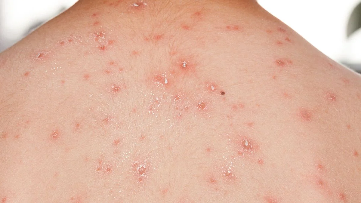 Pasien cacar air berpotensi terkena cacar api pada masa mendatang