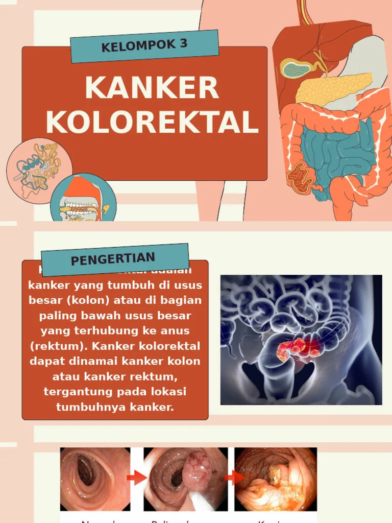 Ahli Ungkap Kanker Kolorektal Dapat Dicegah dengan Pola Hidup Sehat