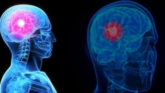 Dokter Ungkap Sakit Kepala Menerus Bisa Jadi Gejala Tumor Otak