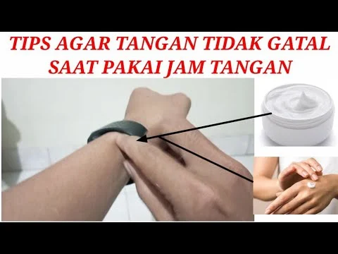 Kulit Gatal Setelah Pakai Jam Tangan? Ini Penyebab dan Solusinya